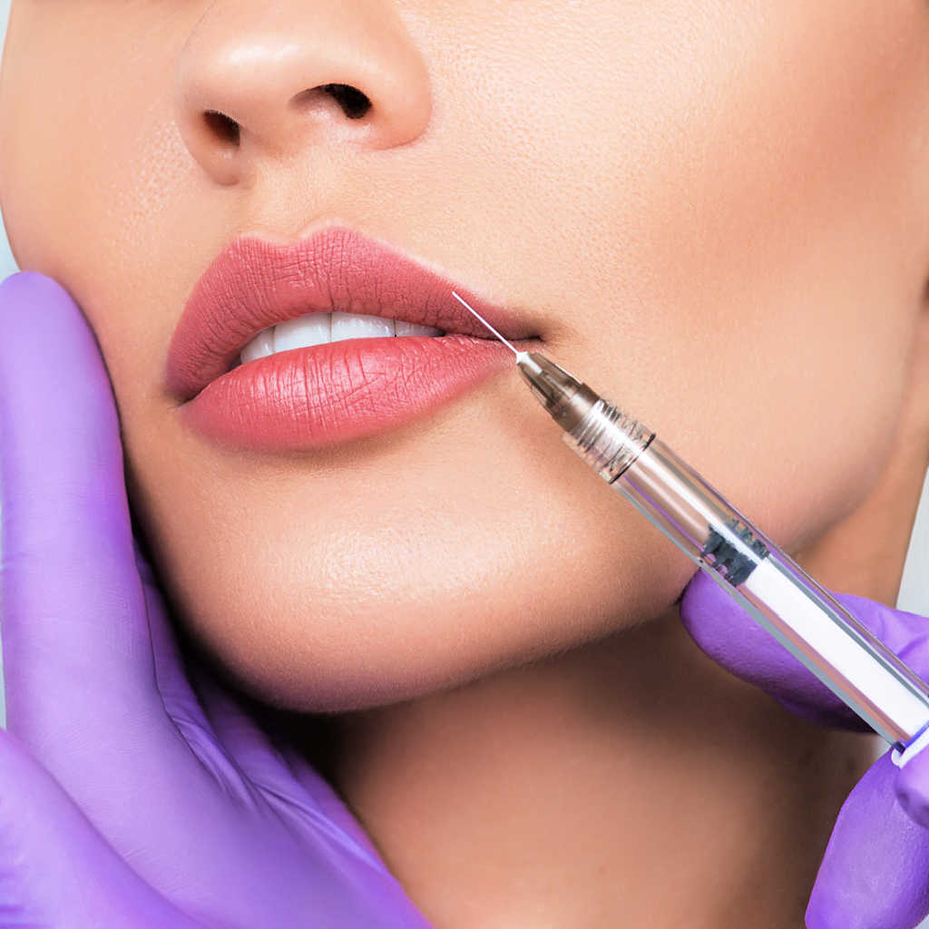 Shows The Start Of Lip Augmentation Treatment On A Patient