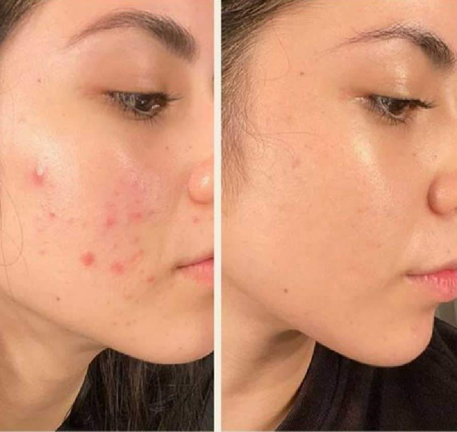 Cystic Acne Treatment Results Shows No Pimples Or Blenishes And No Facial Scars