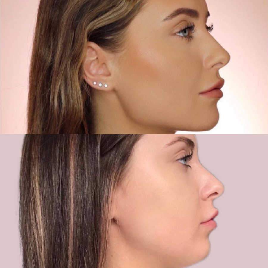 Shows Patient's Chin And Jawline Before And After Procedure