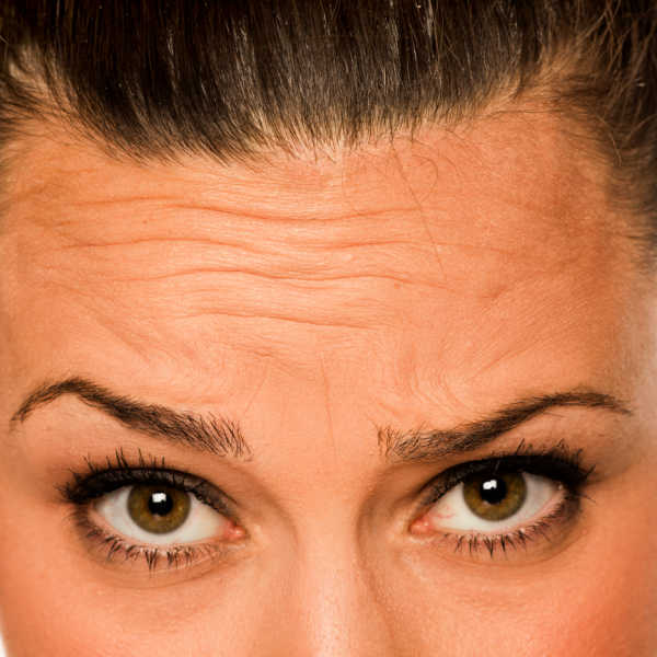 Shows Forehead Prior To Botox Treatment