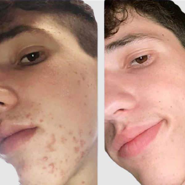 Fungal Acne Treatment Shows Before And After Results For Male Patient