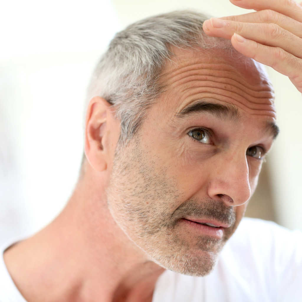 Patient Thinking About Hair Restoration Injections To Stop Hair Loss