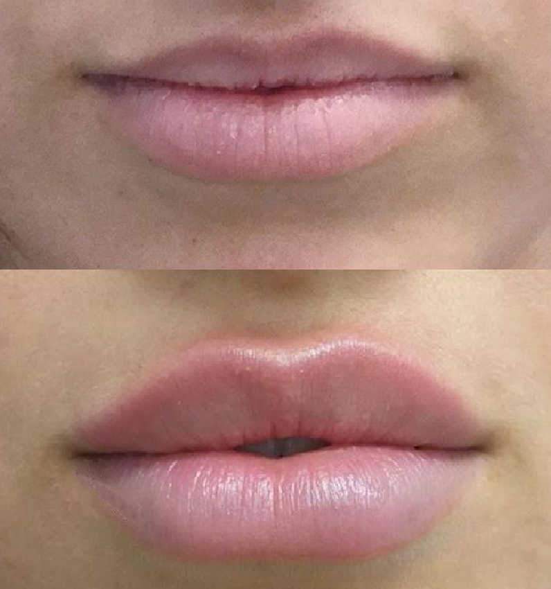 Lip Enhancement Shown After Lip Filler Procedure For This Patient