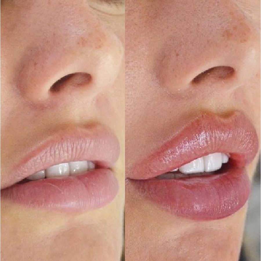 Lip Filler Injection Shows Natural Results On Female Patient