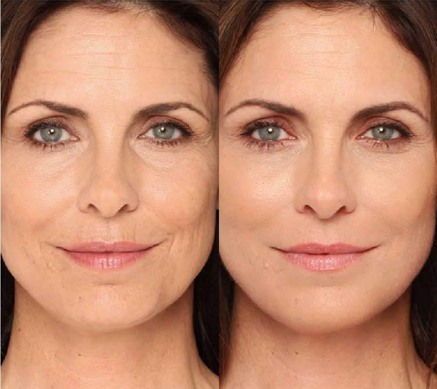 Face Wrinkle Treatment Results Shown For A Mini Face Lift