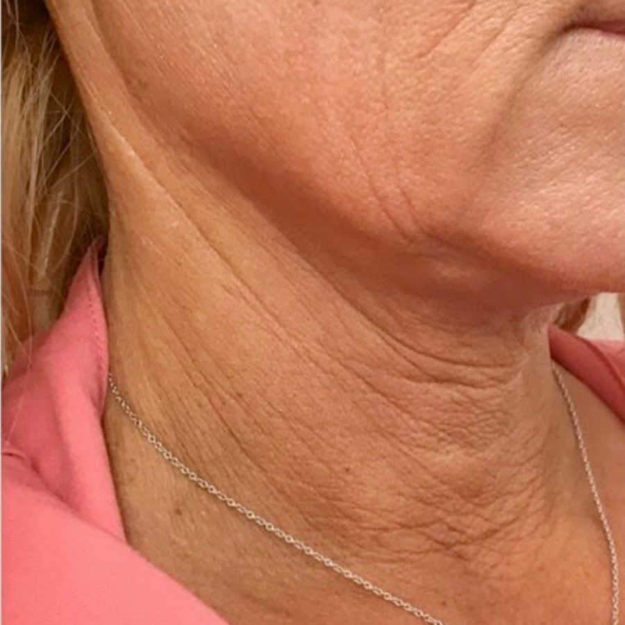 Mini Face Lift Before Treatment Shows Existing Face Wrinkles On Female Patient