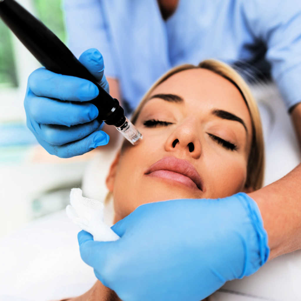 Microneedling Treatment, also called Microdermabrasion Treatment, Being Performed On A Patient