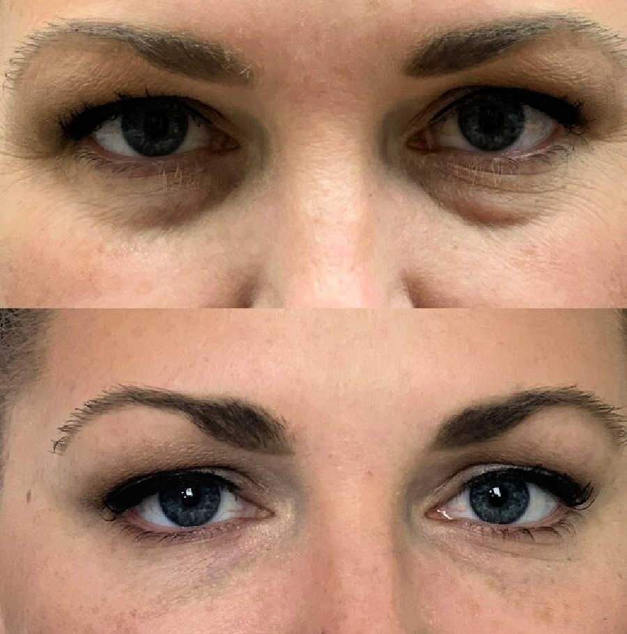 Shows Dark Circles Under The Eyes Disappear After Treatment