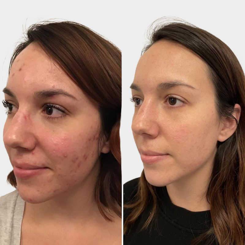 Acne Rosacea Treated Successfully Shows Before And After Treatment Results