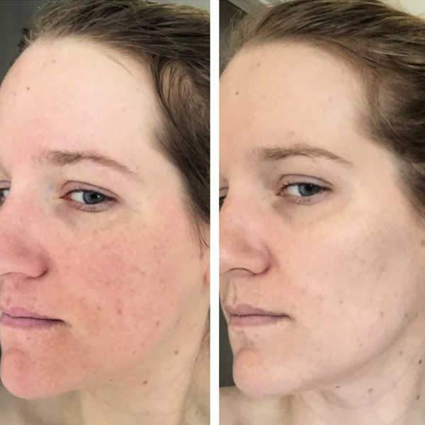 Acne Scars Treatment Shows Before And After Results For Female Patient