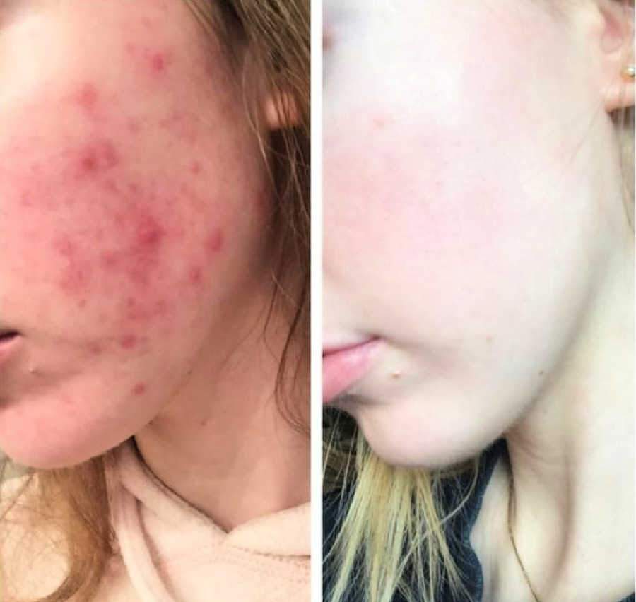 Acne Treatment Results Without Accutane Or Benzoyl Peroxide Shows Clear Skin