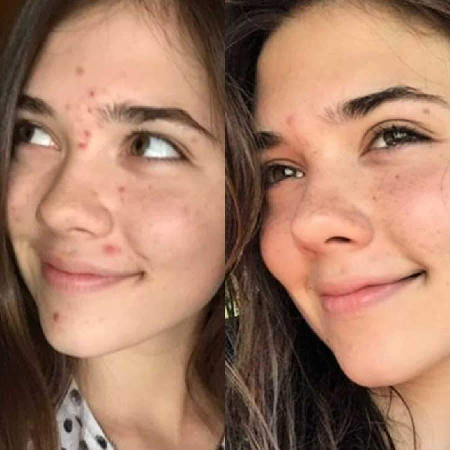 Acne Treatment Shows Pimples And Blemishes Disappear