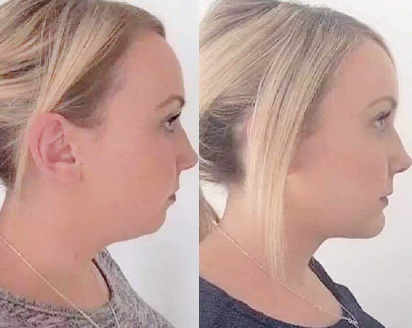 Cellulite Injection For Double Chin Shows Amazing Treatment Results