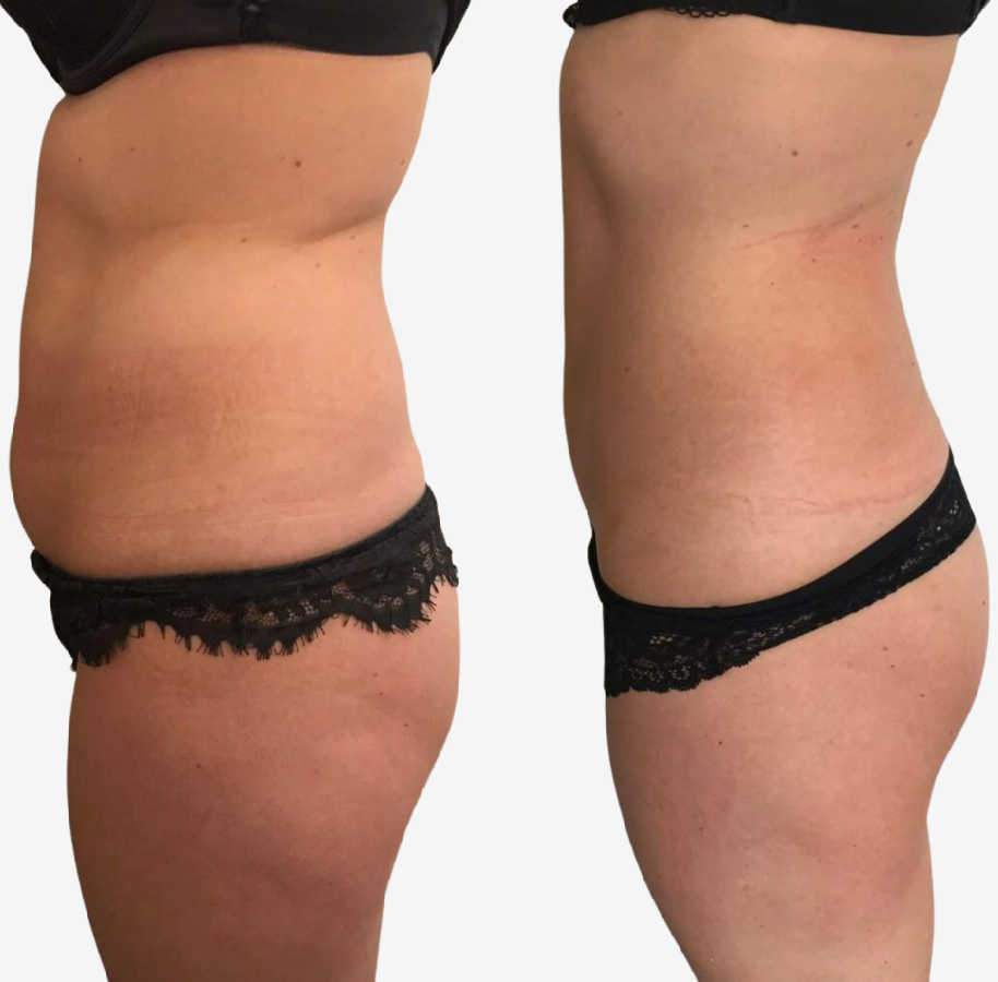 Shows Cellulite Treatment Results And Slimmer Stomach Of Patient