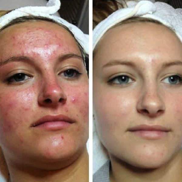 Cystic Acne Treatment Shows Before And After Results