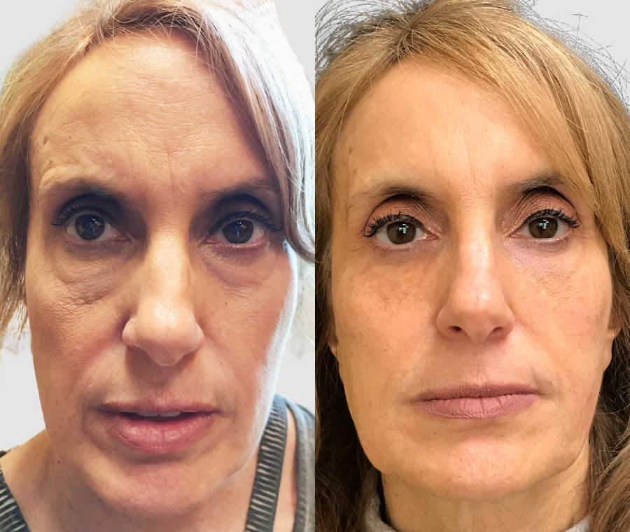 Shows Before And After Treatment Results For Female Patient