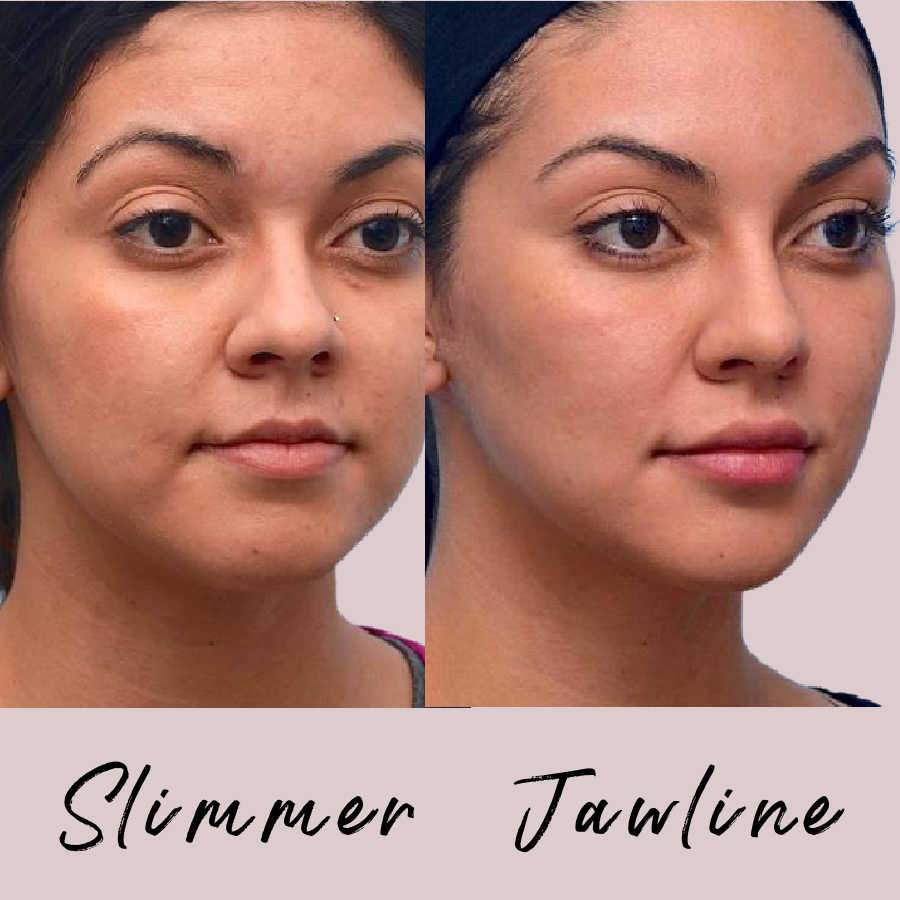 Shows Patient's Jawline Reshaped For A Better Appearance
