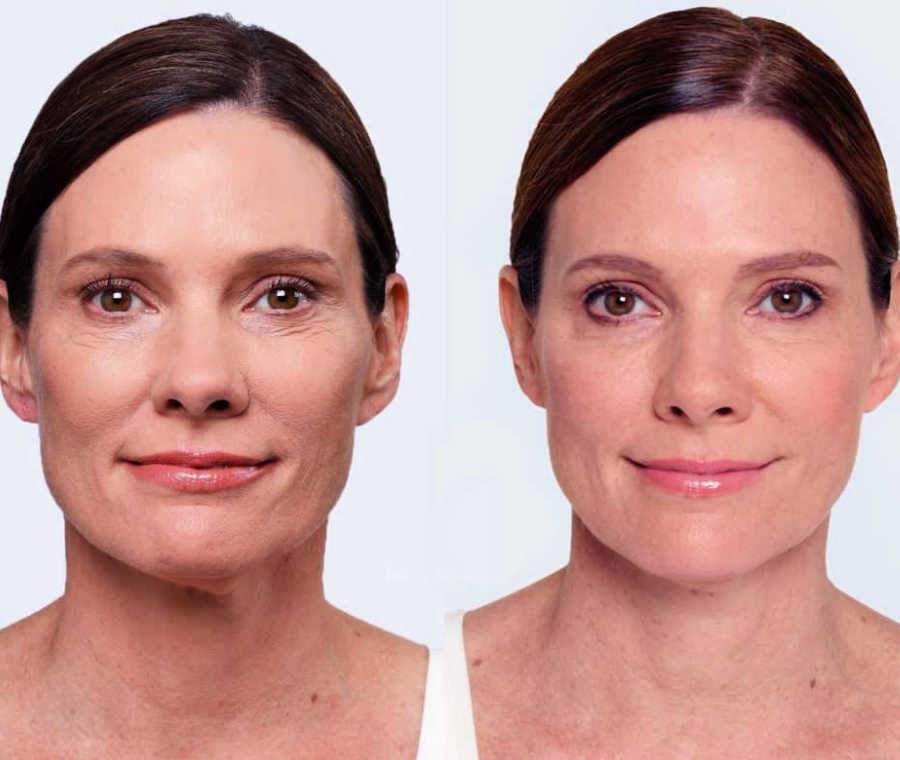 Facial Filler Patient Results Show Face Wrinkles Disappear For A Younger Appearance