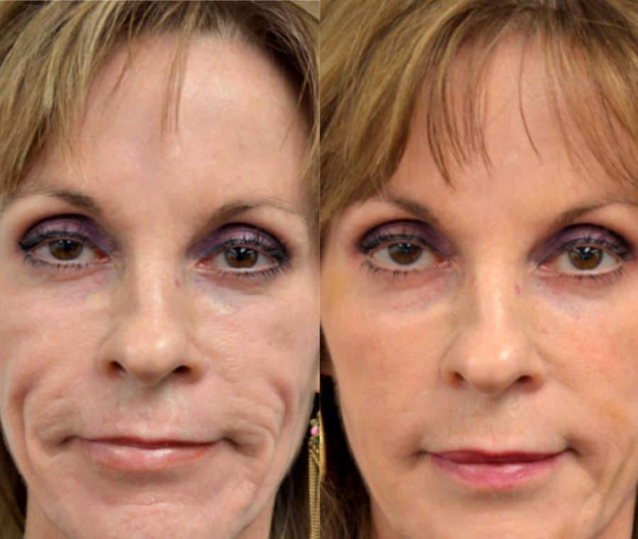 Shows Female Facial Filler Patient Before And After Treatment