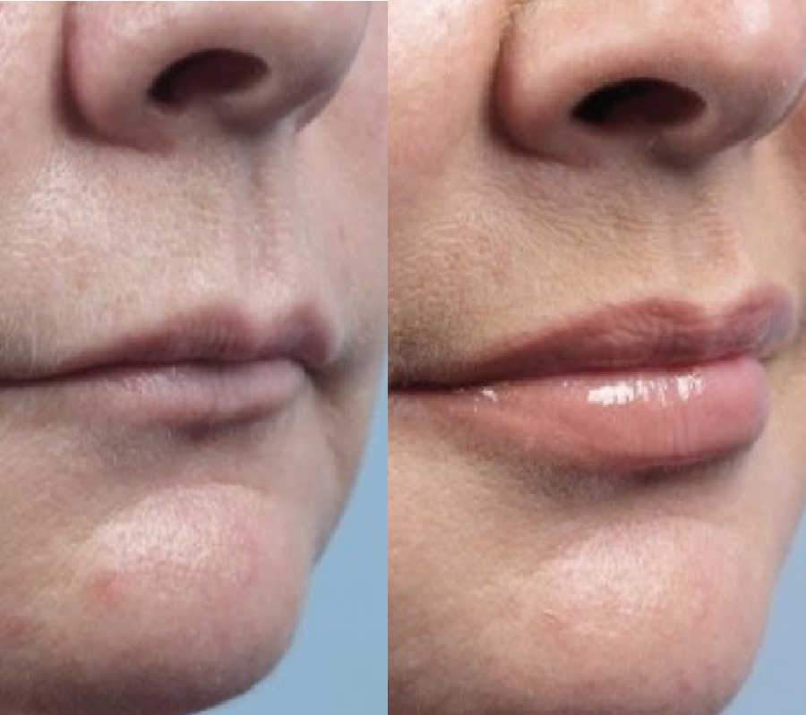 Treatment Results Shows Thin Lips Corrected For Cosmetic Patient