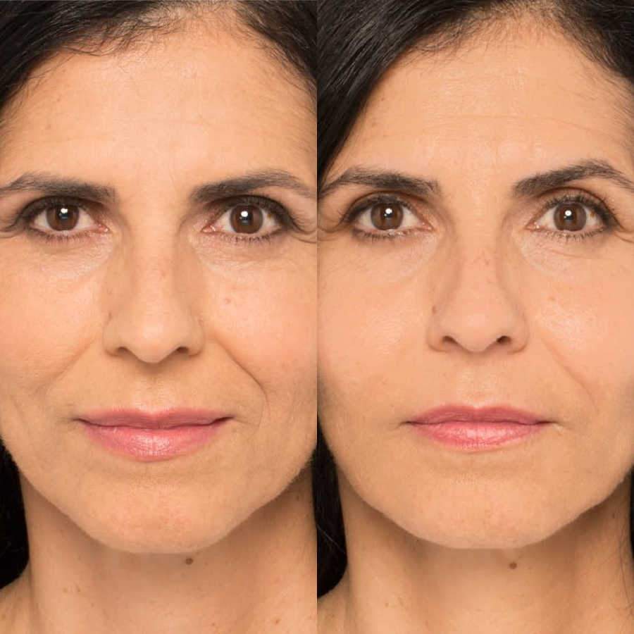 Mini Face Lift Treatment Results Show Significantly Younger Image For Patient