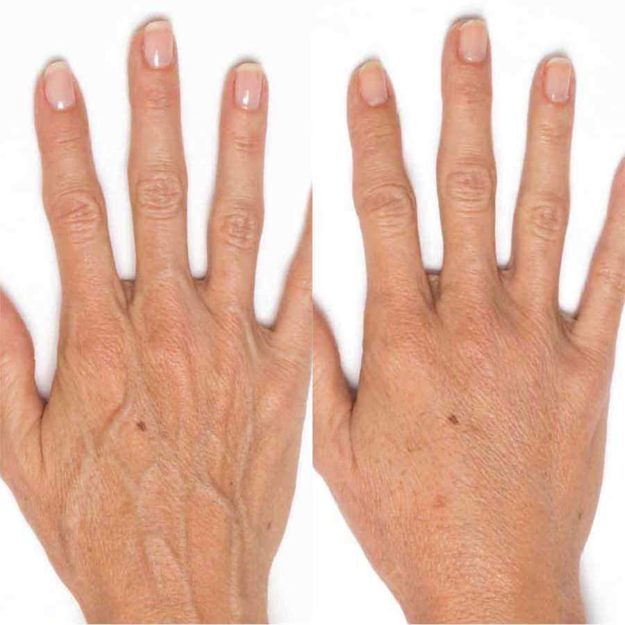 Radiesse Dermal Filler Treatment Results For Hands Shows Hand Wrinkles Disappear On Female Patient