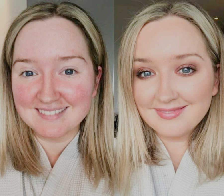 Rosacea Before And After Treatment Shows Redness Disappears