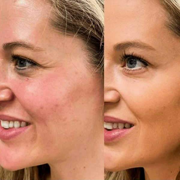 Shows Acne Rosacea Before And After Treament