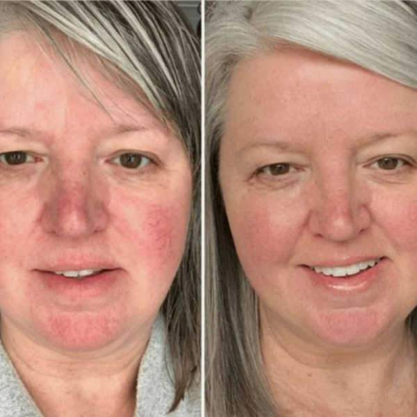 Rosacea On The Nose Before And After Treatment Shows Flushing Minimized