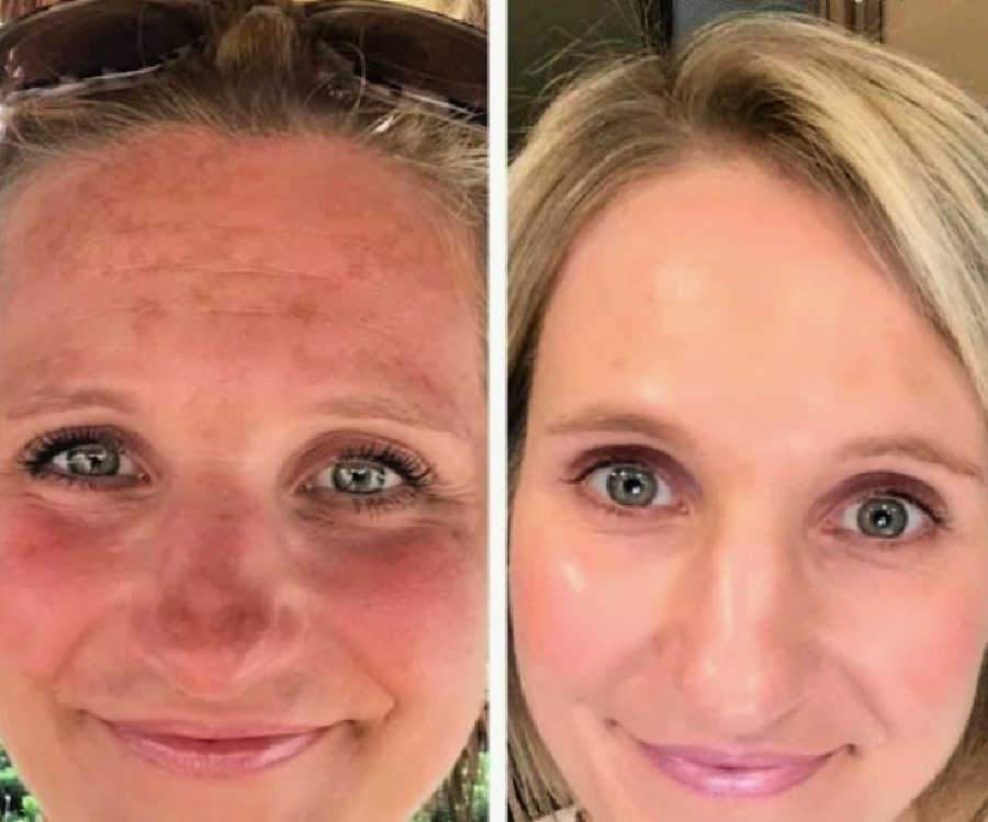 Rosacea Treatment In Our Medical Clinic Shows Before And After Results