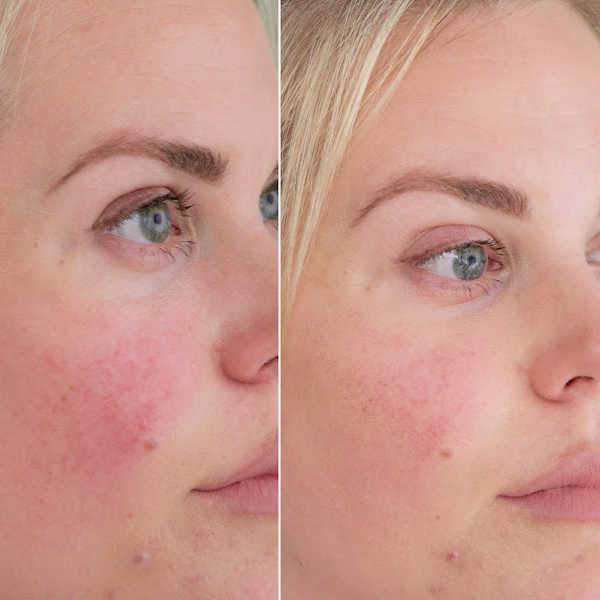 Rosacea Treatment Results At Our Spa Show Blushing Cheeks Minimized
