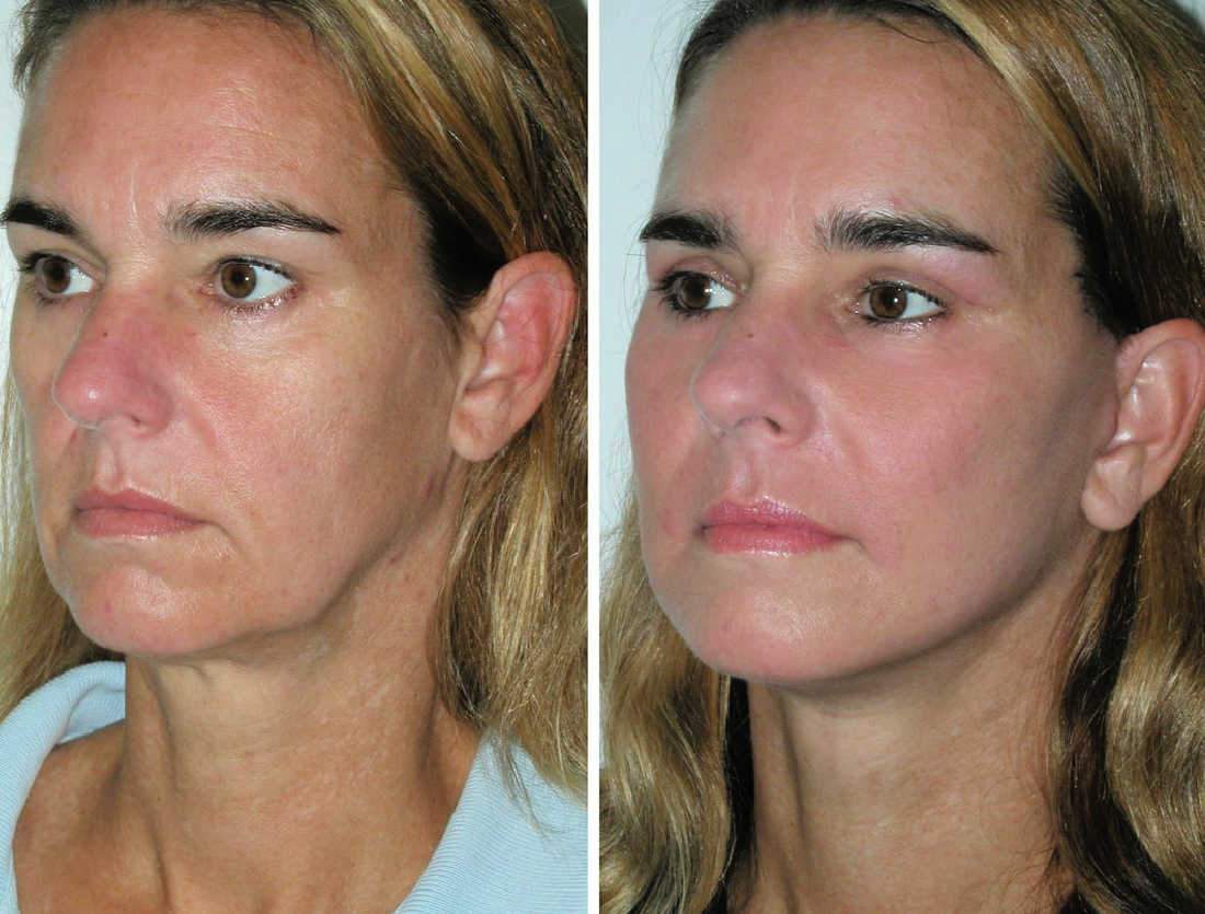 Shows Patients Can Achieve A Younger Appearance With A Nonsurgical Thread Lift