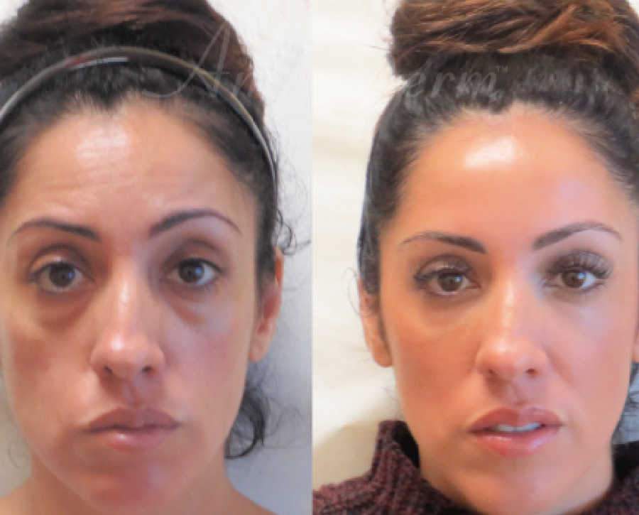 Under Eye Filler Treatment Results Show Dramatic Facial Restoration