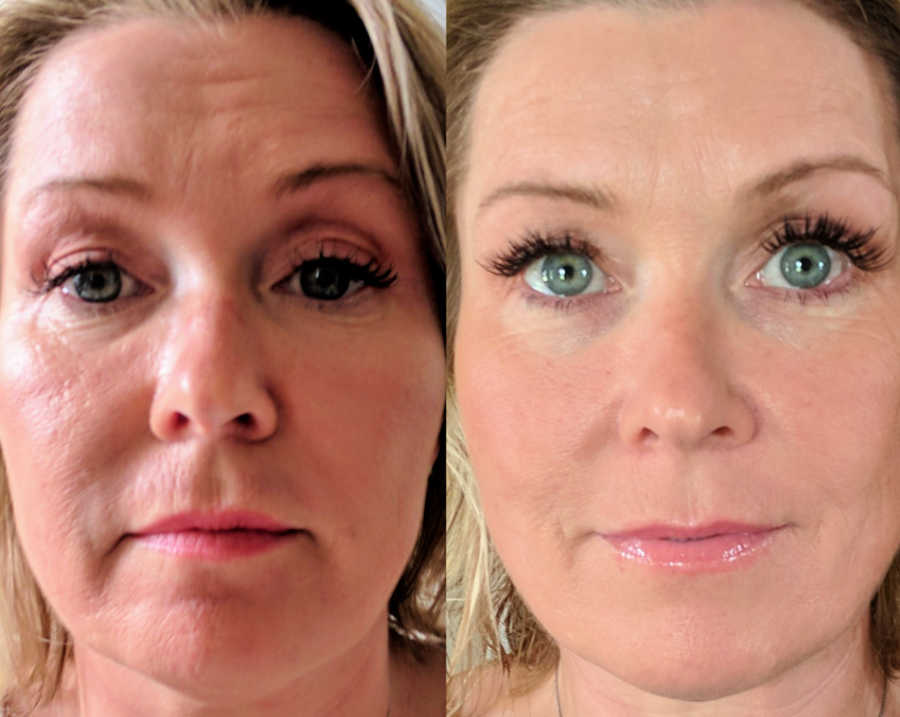 Microneedling Treatment, also called Dermaplaning Treatment Shows Patient's Facial Skin Improvement
