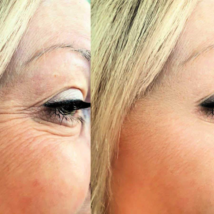 Shows Botox® Injection Results Before And After Procedure